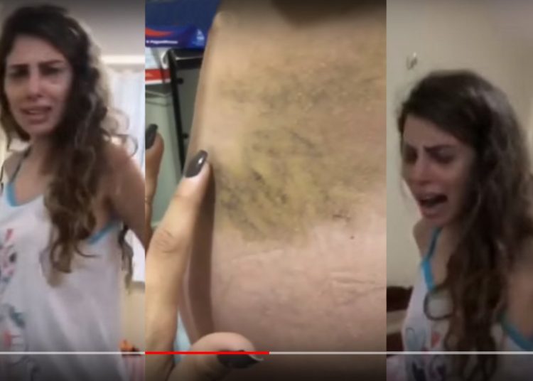 Youtuber Camilla Uckers mostra glúteos após infecção de silicone e diz: 'médico só queria seguidores' | Foto: Reprodução / Instagram