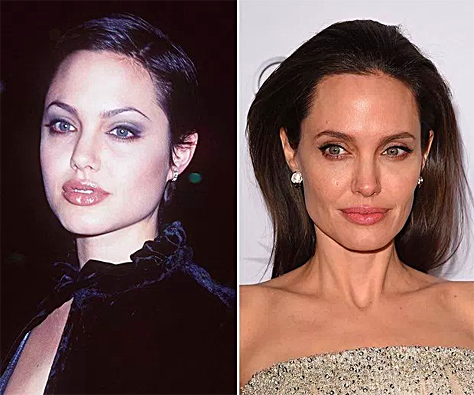 Pretende fazer uma bichectomia em Goiânia? Saiba tudo sobre a cirurgia pela qual a atriz Angelina Jolie já passou | Foto: Reprodução