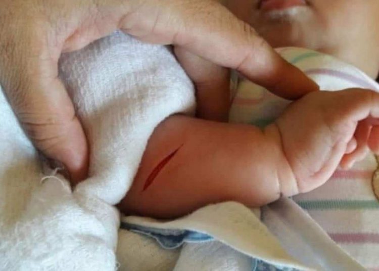 bebê esfaqueado precisou levar quatro pontos no braço direito após ser alvo de assaltante | Foto: Reprodução