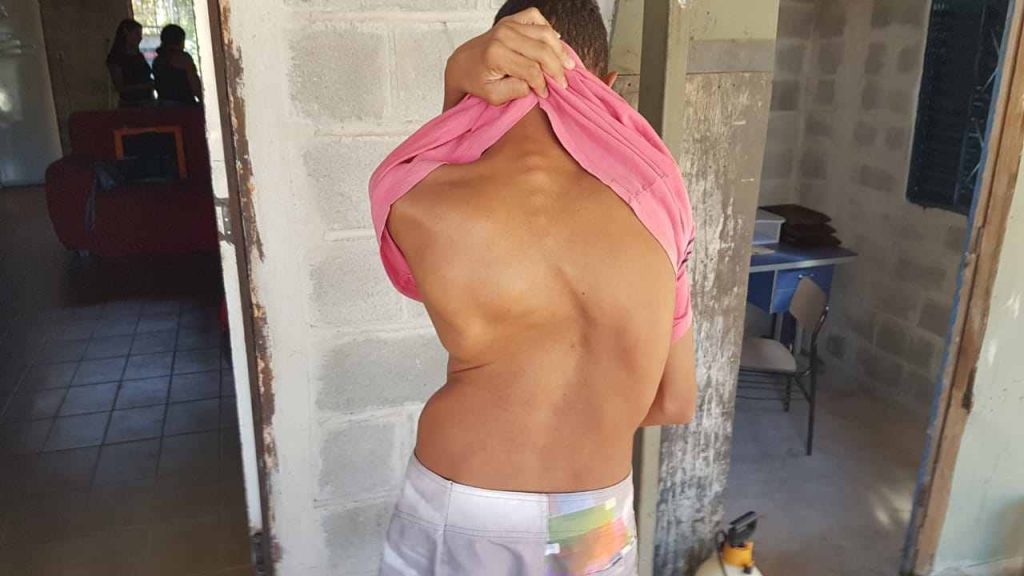 Gabriel de Almeida, 18, enfrenta escoliose, grave distorção na coluna, há 7 anos enquanto o SUS posterga sua cirurgia | Foto: Folha Z