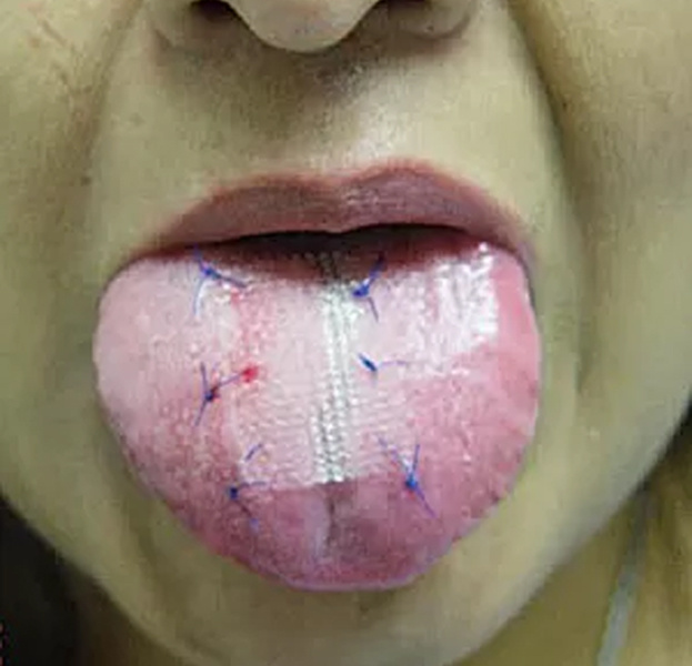 Malha supralingual torna a ação de comer dolorida | Foto: Reprodução