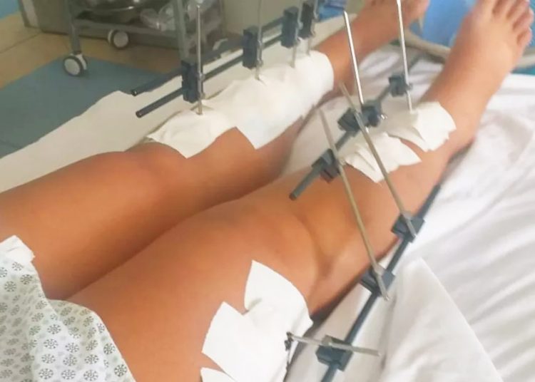 Mulher atropelada pelo ex teve fratura nas 2 pernas em Aparecida de Goiânia | Foto: Reprodução