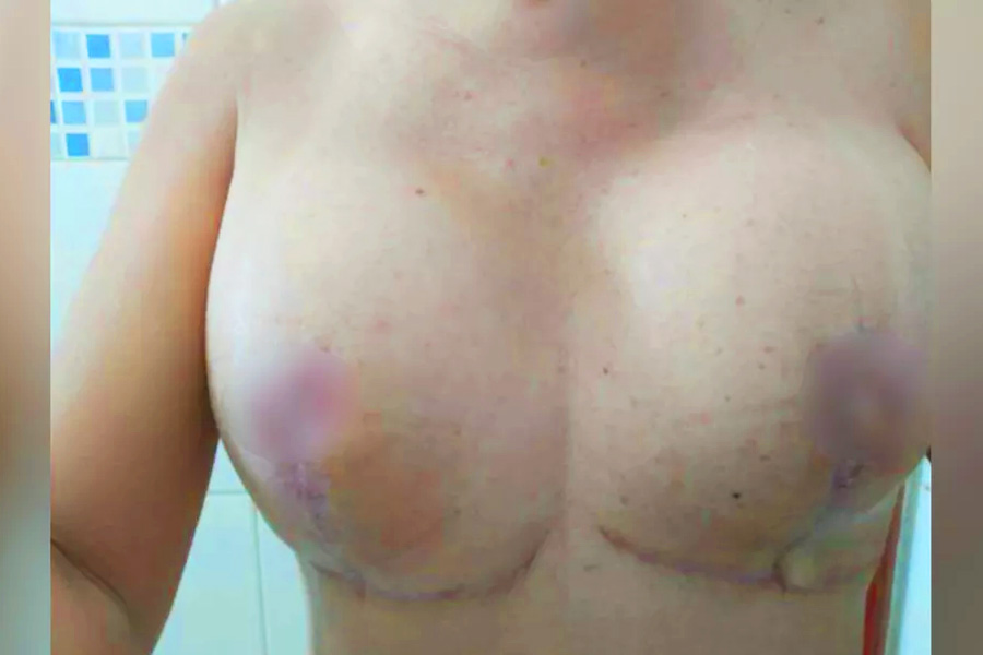 Auréolas de mulher necrosaram após cirurgia plástica realizada em Goiânia | Foto: Arquivo Pessoal