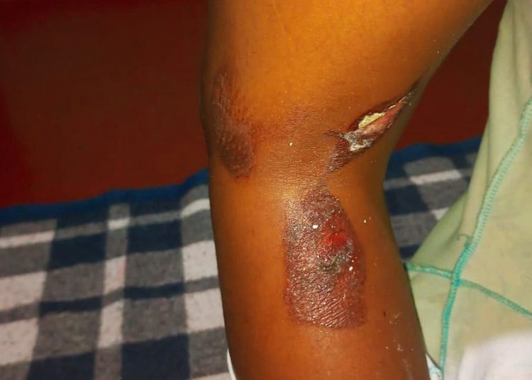 Polícia Civil procura por mãe suspeita de queimar filha de 8 anos com colher aquecida no fogo | Foto: Divulgação / PCGO