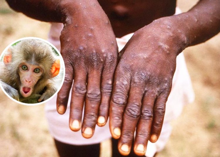 Varíola dos macacos | Foto: EBC