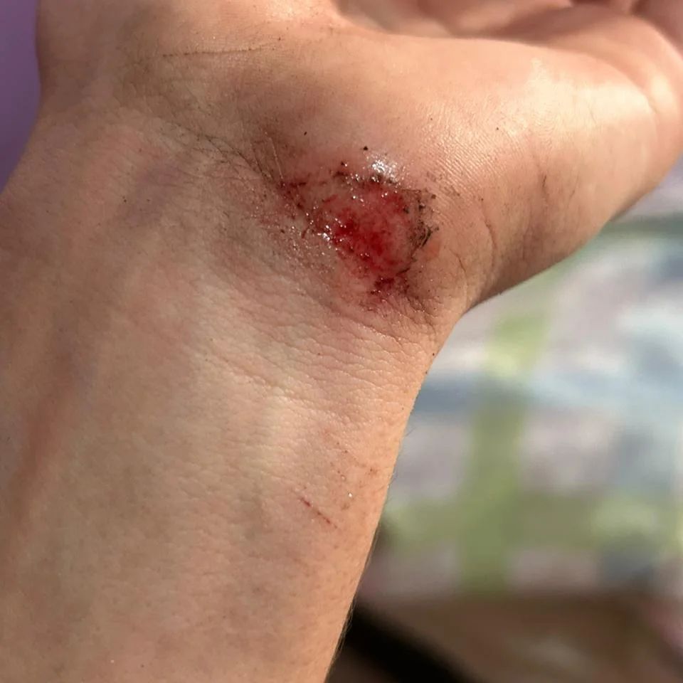 Vítima ficou com ferimentos na mão | Foto: Divulgação
